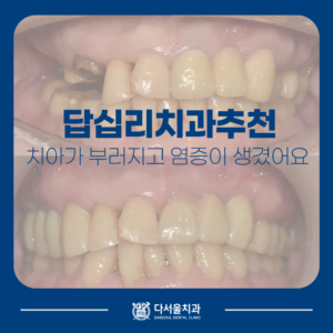 치과치료 전후