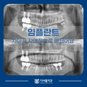 임플란트 치료 전후