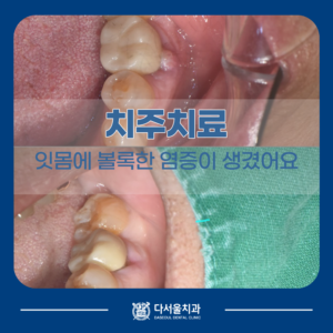 잇몸치료 전 후
