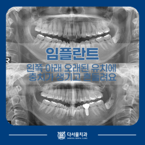 임플란트 치료 전후