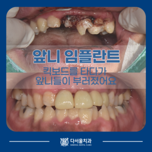 앞니임플란트 사례