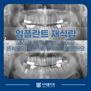 임플란트 재식립