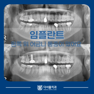 임플란트 전후