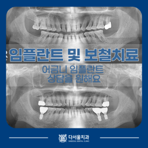 임플란트 치료 전 후